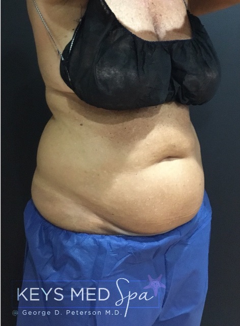 before CoolSculpting on abdomen