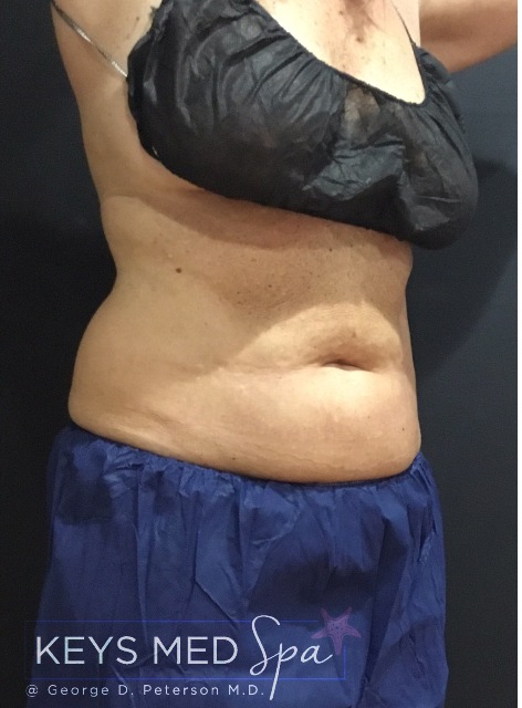 after CoolSculpting on abdomen