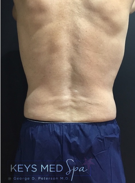 after CoolSculpting on flanks