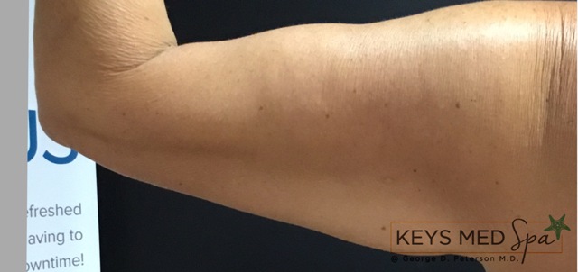 before coolsculpting on arms