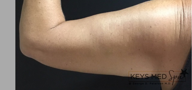 tighter skin after coolsculpting on arms