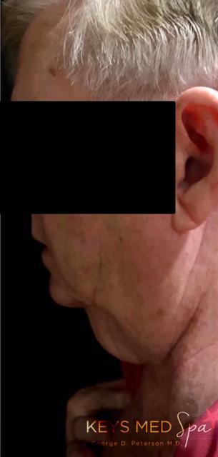 before coolsculpting left profile view case 1