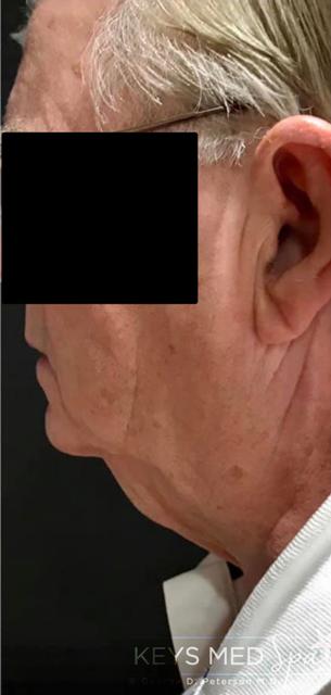 after coolsculpting left profile view case 1