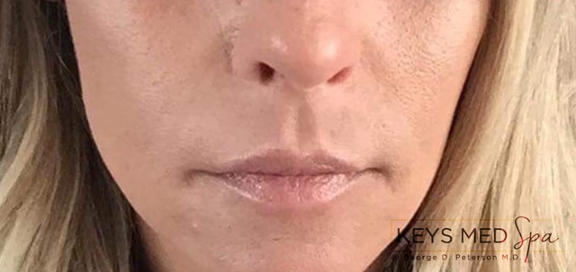 smoother skin after dermal fillers