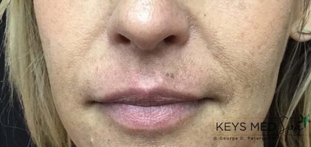 before dermal fillers