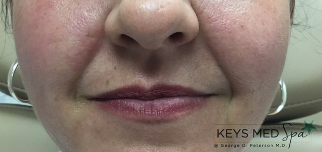 nasolabial folds before fillers