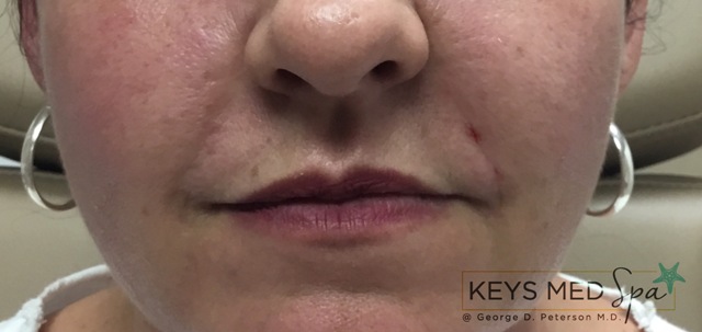 nasolabial folds after fillers