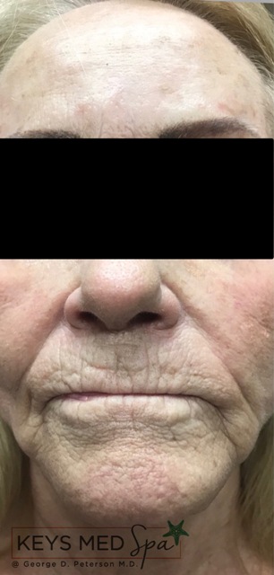 before dermal filler treatment