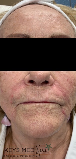after dermal filler treatment