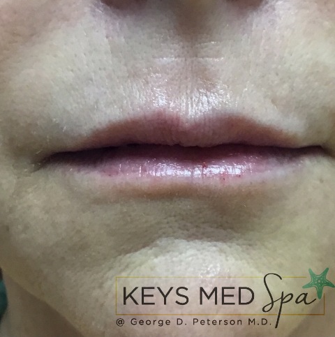 lips after treatment front view