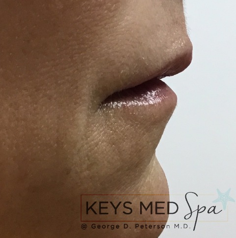 lips after fillers profile view
