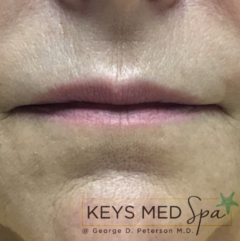 lips before treatment front view