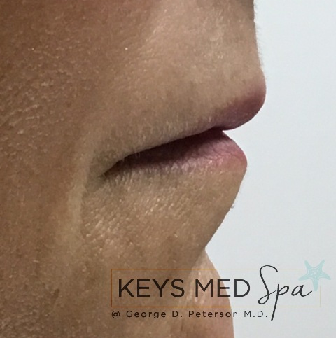 lips before fillers profile view