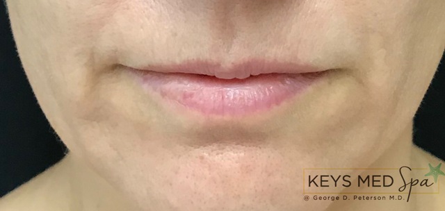 thin lips before fillers