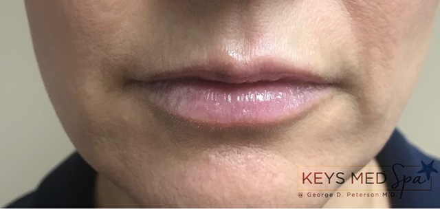 prominent lips after fillers