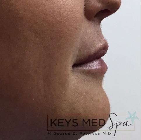 after lip fillers right profile view