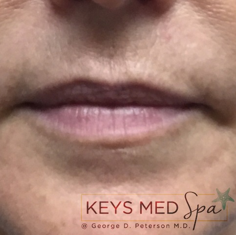 before lip filler treatment front view