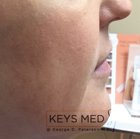 before lip fillers right profile view