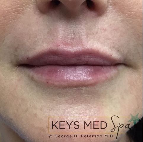 after lip filler treatment front view