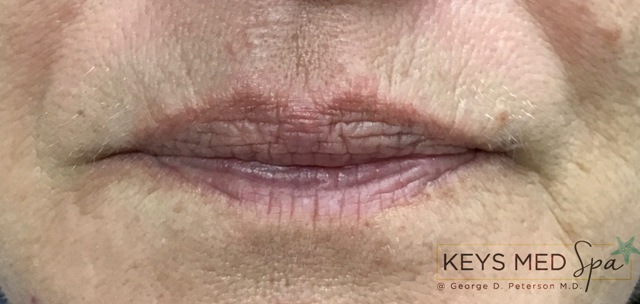 lips -before fillers