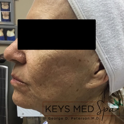 after SkinCeuticals treatment profile view