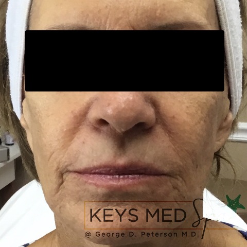 after SkinCeuticals treatment front view