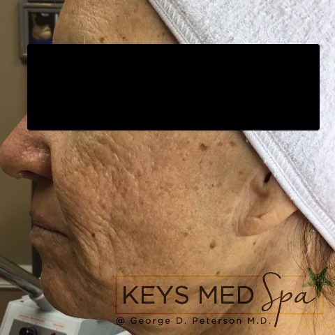 before SkinCeuticals treatment profile view