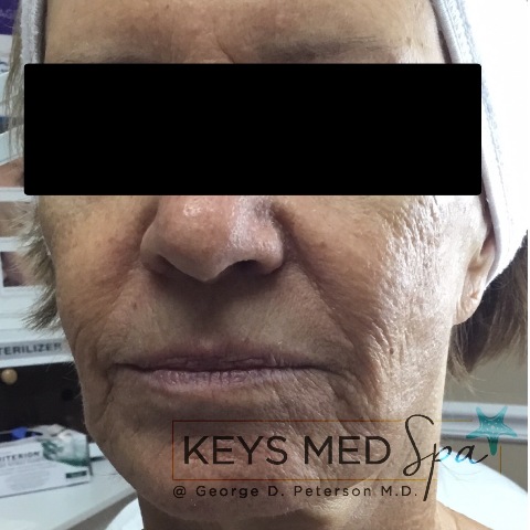 before SkinCeuticals treatment front view