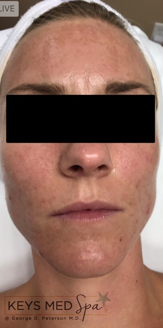 before facial treatment