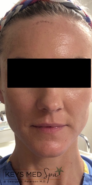 after facial treatment