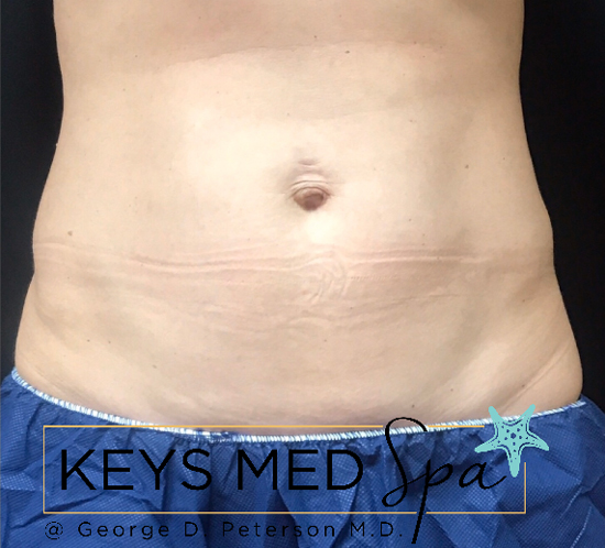 after coolsculpting to abdomen