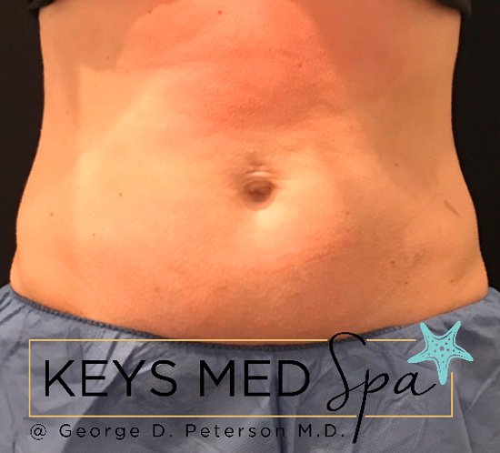 before coolsculpting to abdomen