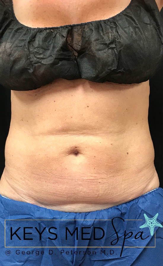before coolsculpting to midsection