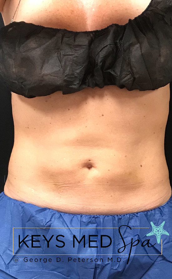 coolsculpting to midsection