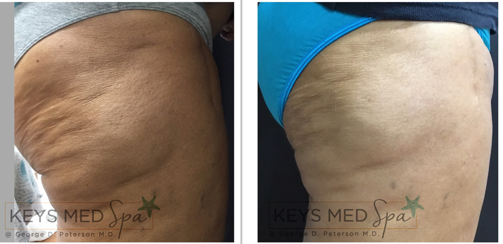 back of thighs before and after coolsculpting