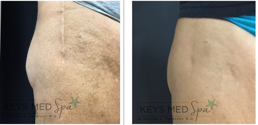 coolsculpting on thighs before and after closeup