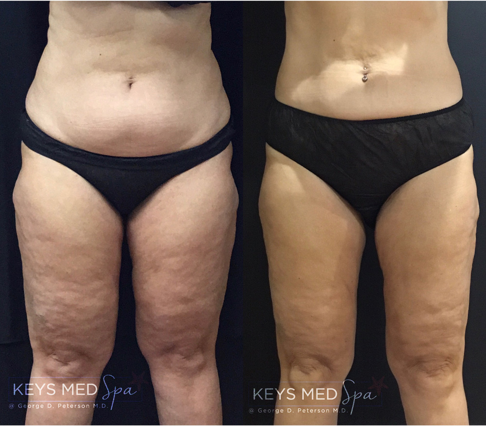 before and after coolsculpting on female patient comparison
