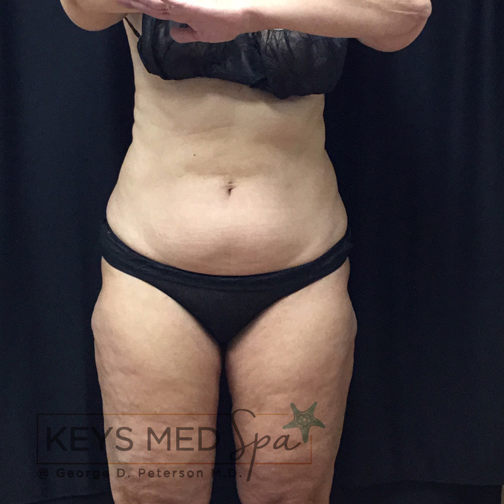 abs before coolsculpting