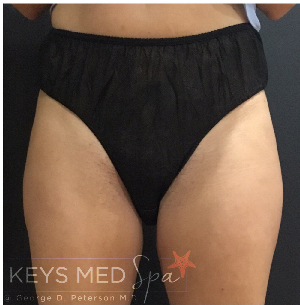 thighs coolsculpting after front view