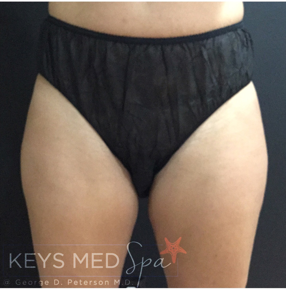 thighs coolsculpting before front view