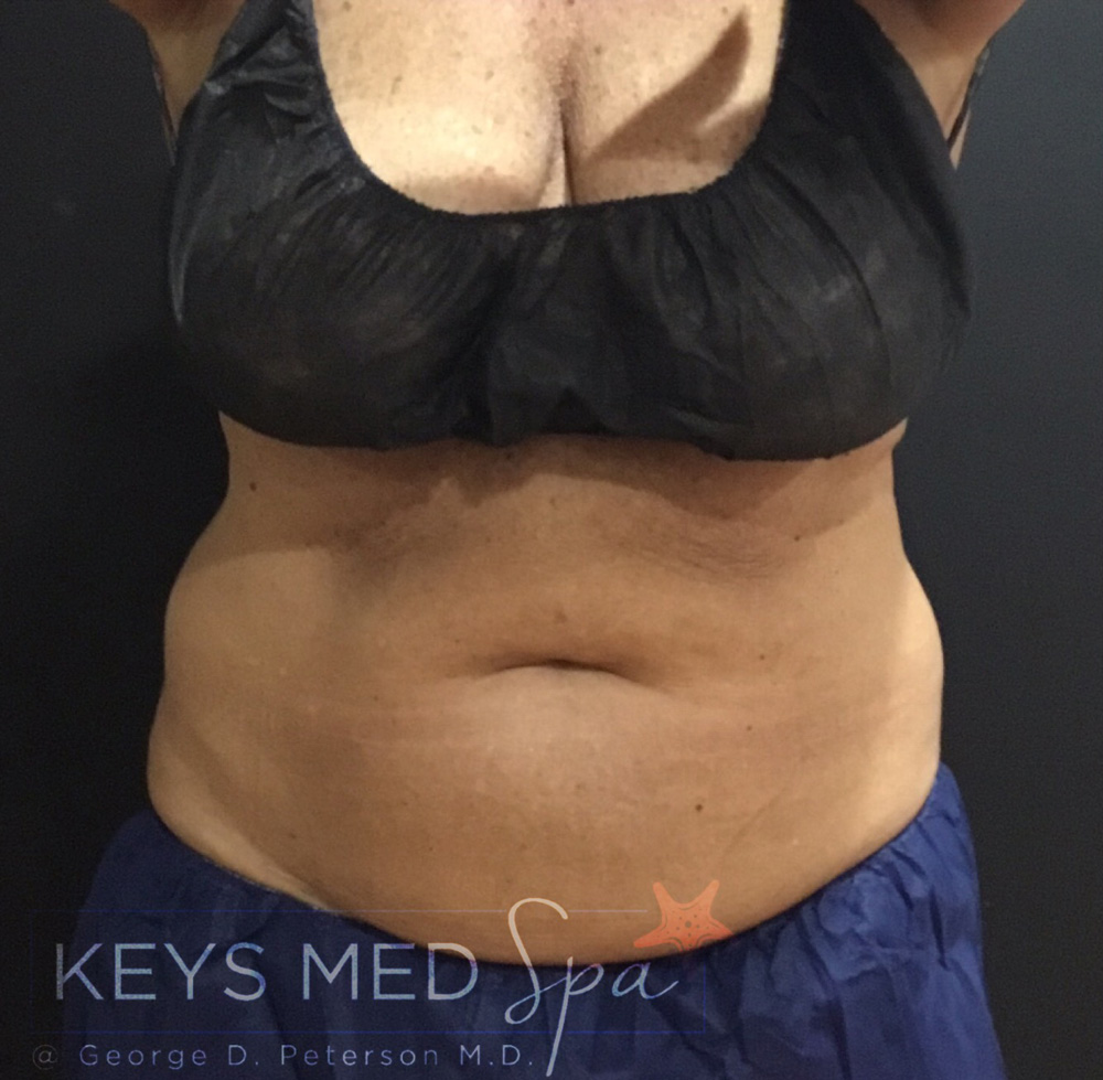 front view abdomen after coolsculpting