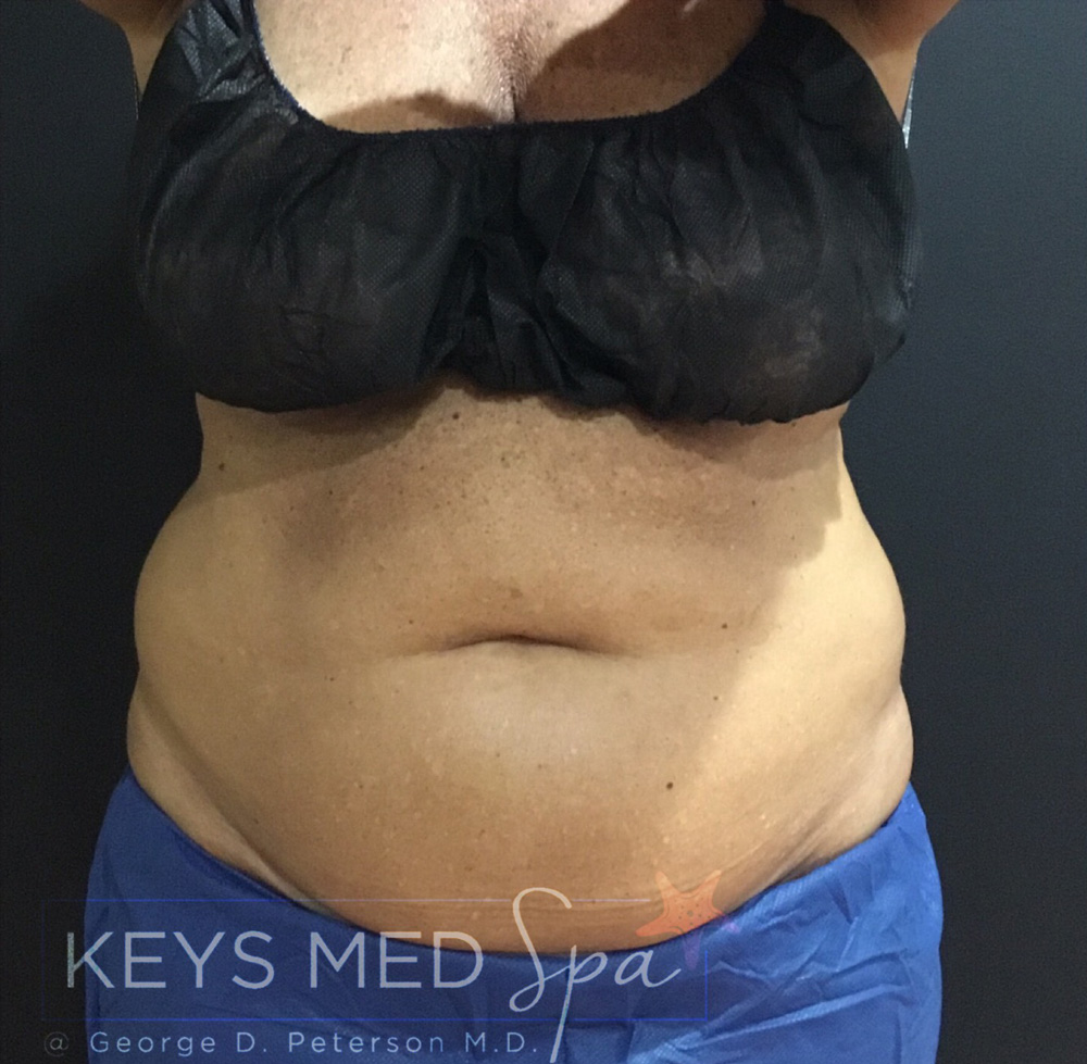front view abdomen before coolsculpting