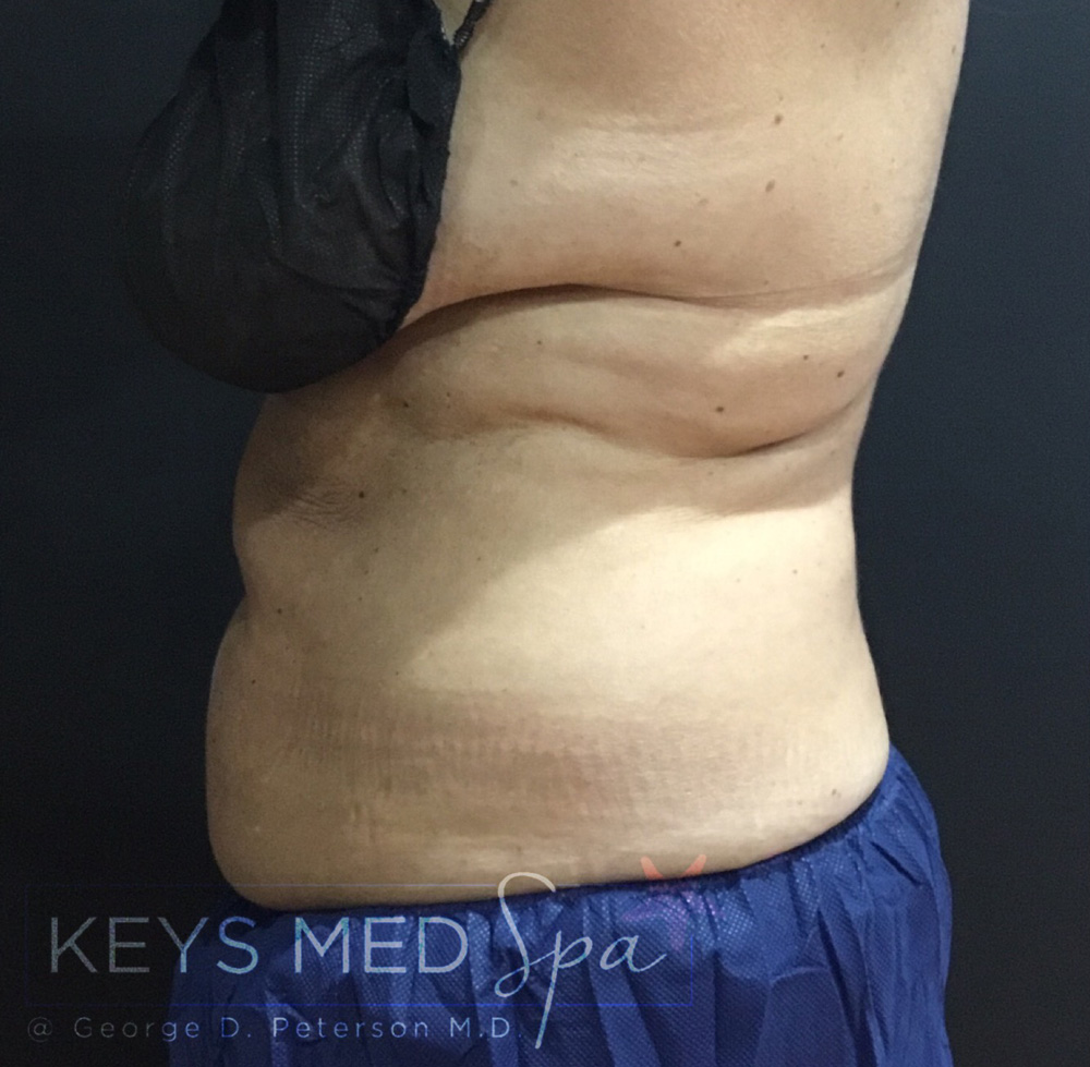 abdominal area after coolsculpting left profile view