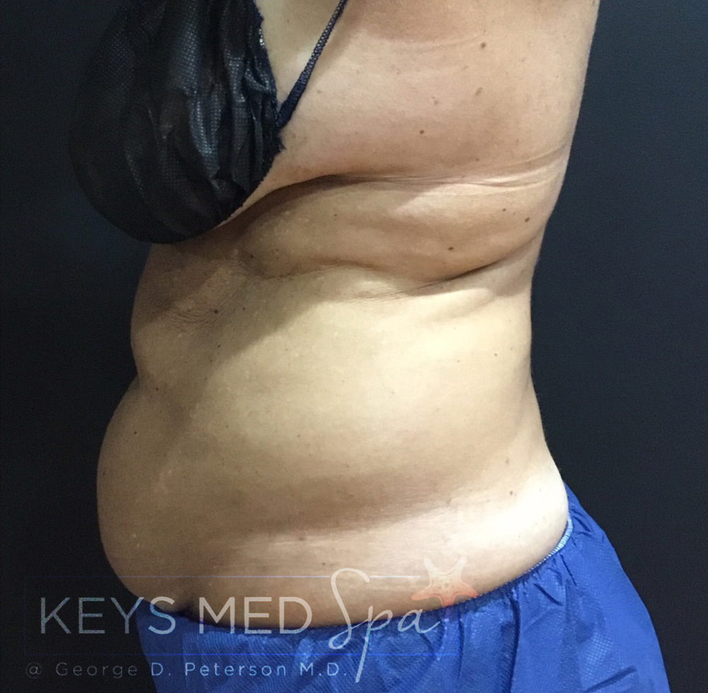 abdominal area before coolsculpting left profile view