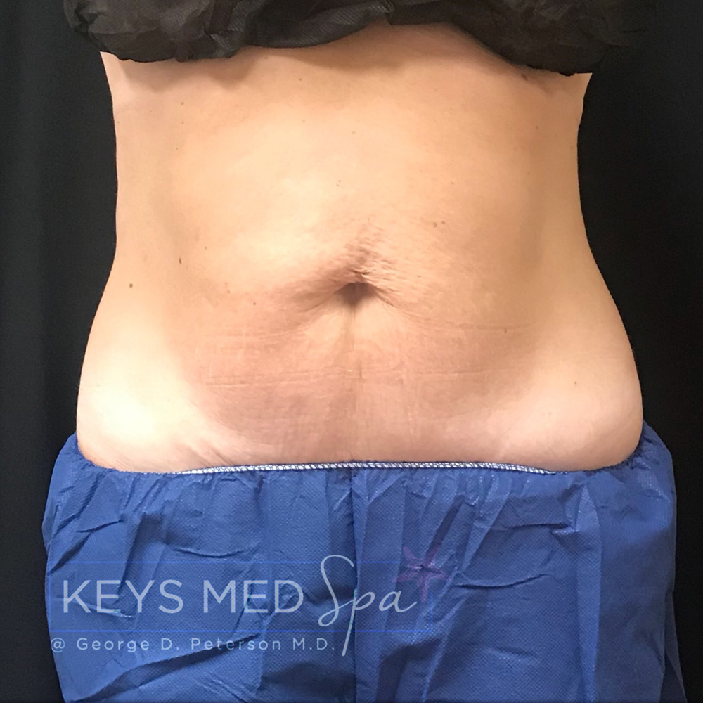 abdominal area after coolsculpting