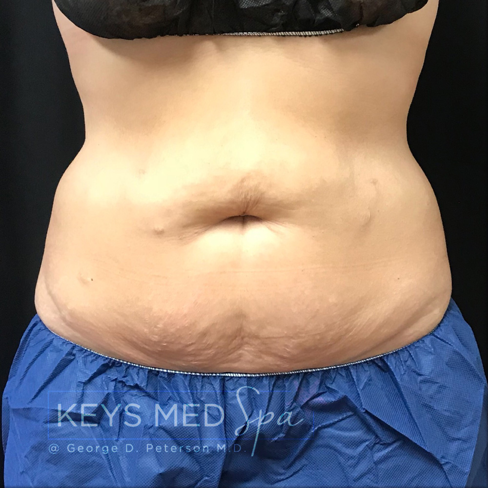 abdominal area before coolsculpting