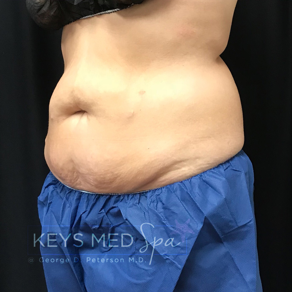 female patient abdomen before coolsculpting left oblique view