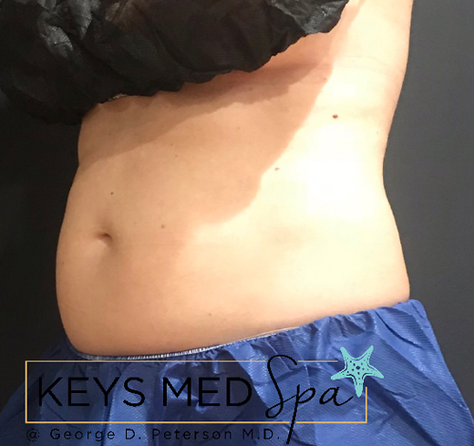 abdomen before coolsculpting