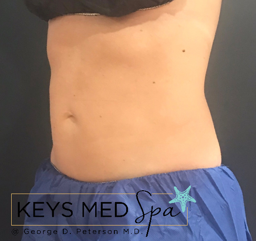 flatter abdomen after coolsculpting