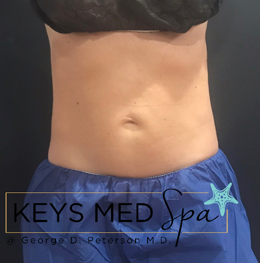 female patient's flanks after coolsculpting treatment